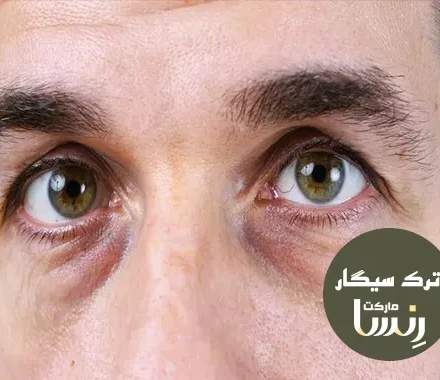 آیا سیگار باعث گودی زیر چشم میشود؟ ترک سیگار رنسا