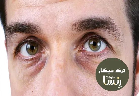 آیا سیگار باعث گودی زیر چشم میشود؟ ترک سیگار رنسا